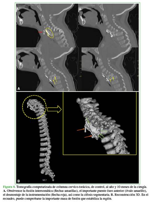Tomograf&iacute;a computarizada de columna cervico-tor&aacute;cica, de control, al a&ntilde;o y 10 meses de la cirug&iacute;a. A. Obs&eacute;rvense la fusi&oacute;n intersom&aacute;tica (flechas amarillas), el importante puente &oacute;seo anterior (&oacute;valo amarillo), el desmontaje de la instrumentaci&oacute;n (flecha roja), as&iacute; como la cifosis segmentaria. B. Reconstrucci&oacute;n 3D. En el recuadro, puede comprobarse la importante masa de fusi&oacute;n que estabiliza la regi&oacute;n.