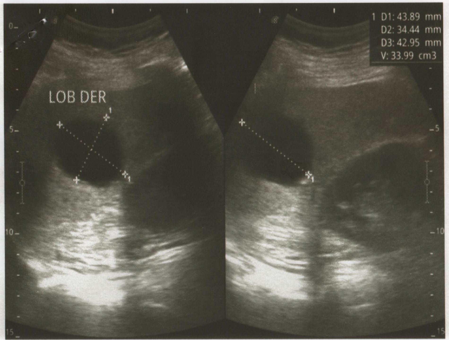 Lóbulo derecho con
presencia de imagen de aspecto quístico de bordes regulares, y reforzamiento
posterior