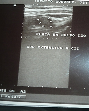 Placa mixta en bulbo.