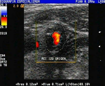 Eco doppler
  carotideo