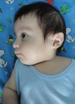 Lateral izquierdo a los
3 meses y 15 días de edad, se puede apreciar pabellón auricular rotado
posteriormente, en forma de asa, micrognatia y cuello corto. Anteroposterior:
región frontal amplia, el puente nasal es cóncavo y la punta bulbosa. Lateral
derecho se observa pabellón auricular rotado posteriormente, apéndice
preauricular pediculado y el cuello es corto.