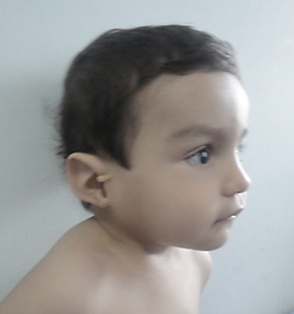 Lateral derecho al año
y cuatro meses de edad, se puede apreciar pabellón auricular rotado
posteriormente, en forma de asa y apéndice preauricular, micrognatia y cuello
corto. Lateral izquierdo: región frontal amplia, puente nasal es cóncavo y la
punta bulbosa.