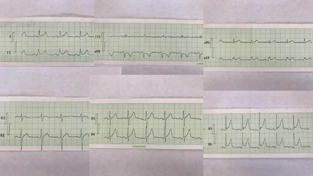 Electrocardiograma realizado al paciente