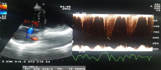 Ecocardiograma Transtorácico
realizado al paciente.