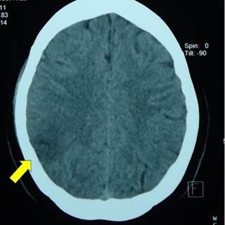 Tomografía computarizada de cráneo en corte axial: Se
observa imagen hipodensa en zona parietal derecha (flecha amarilla)