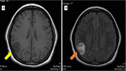 Resonancia magnética de encéfalo simple A Secuencia en T1 con evidencia de zona de hipointensidad circunscrita en lóbulo parietal derecho flecha amarilla B Secuencia en FLAIR con zona de hiperintensidad en lóbulo parietal derecho sugerente de ictus hiperagudo tardío flecha naranja Se concluye área de infarto con componente de microhemorragia corticalsubcortical