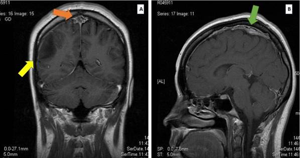 Resonancia magnética de encéfalo con gadolinio en secuencia T1 A En corte coronal se observa defecto de llenado sugerente de trombosis en seno venoso sagital flecha naranja y zona hipointensa correspondiente al área de isquemia en lóbulo parietal flecha amarilla B En corte sagital se aprecia seno sagital superior con presencia de trombo flecha verde