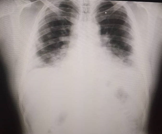 Radiografía de tórax donde se evidencia infiltrado bilateral alveolar con
presencia de derrame pleural