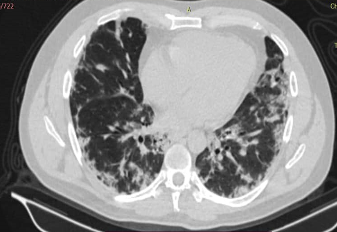 Tomografía
de tórax de alta resolución, donde se evidencia los signos de fibrosis con
bronquiectasias e infiltrado reticular