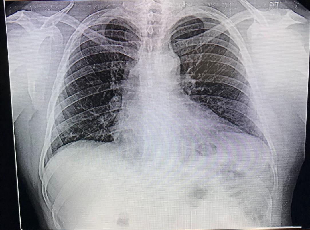 Radiografía de tórax
posterior a inicio de tratamiento, se evidencia mejoría con respecto al
ingreso