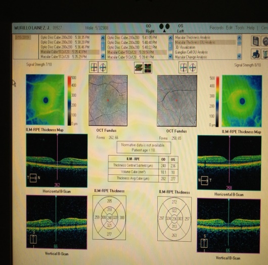 Oct de macula