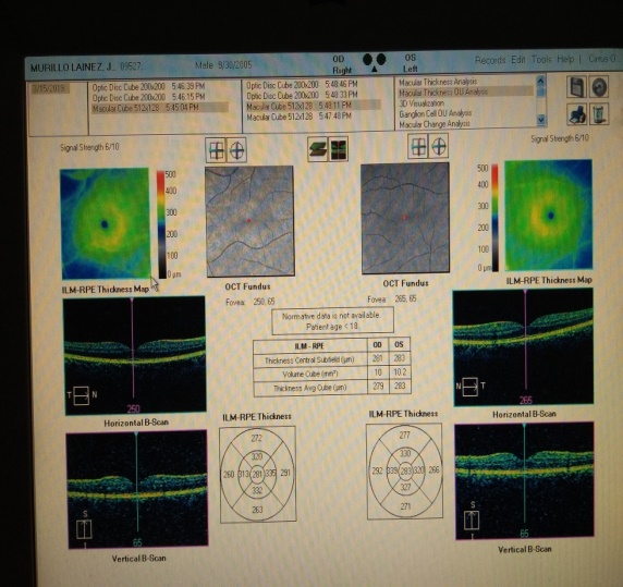 Oct de macula