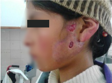 Esporotricosis cutánea fija en región pre auricular izquierda.