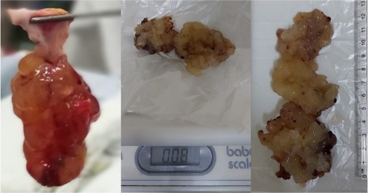 La imagen muestra la pieza quirúrgica, el tamaño y peso del mixoma, que
posee una longitud de 13 centímetros y un peso de 0,08 gramos. 
