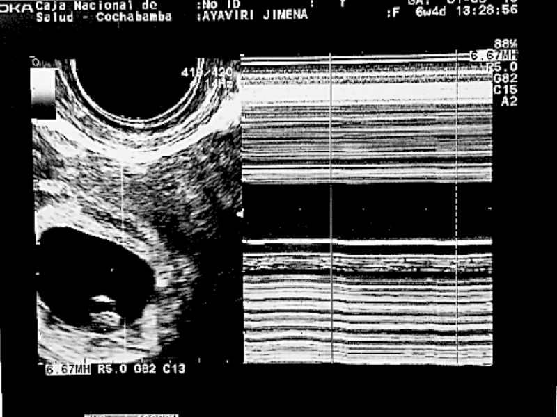 Transvaginal
ultrasound orthotopic gestational sac with single live 7 mm LCC embryo with cardiac
activity