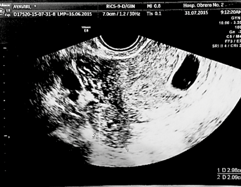 31 x 19 mm
ovoid adnexal formation in right adnexa; heterotopic pregnancy: one 6.4 week
viable intrauterine and one right tubal ectopic.