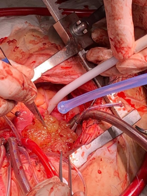 The image
shows the myxoma in the right atrial cavity during the trans-surgical period.