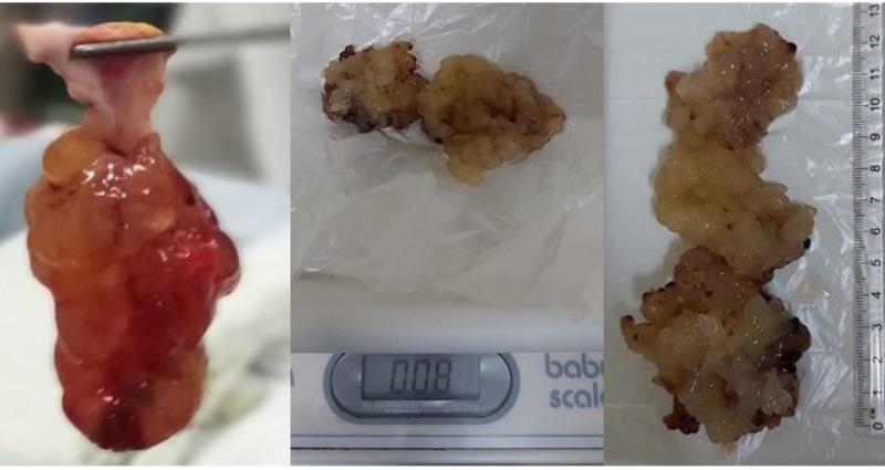 The image
shows the surgical specimen, the size and weight of the myxoma, which has a
length of 13 centimeters and a weight of 0.08 gram