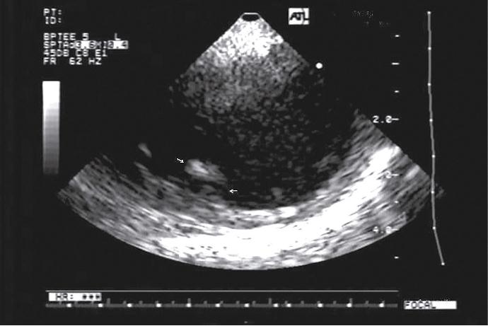 Ecocardiograma transesofágico
donde se evidencia a nivel da le aorta 
ascendente una placa aterosclerótica complicada con trombo móvil compatible con  debrís aórtico.