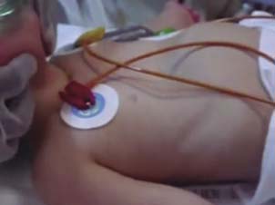 Tiraje intercostal, restracción esternal y disociación toracoabdominal.