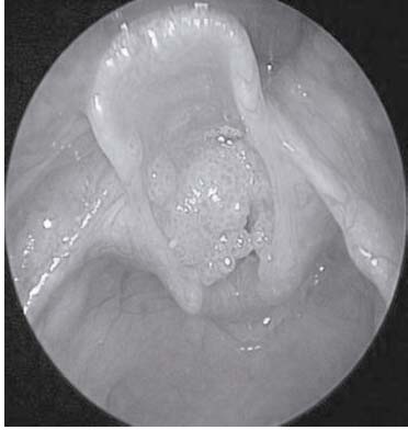 Papilomatosis
Laríngea casi completamente obstructiva.