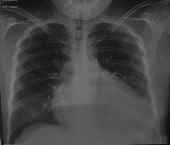 Radiograf&iacute;a de t&oacute;rax:
Cardiomegalia severa III/IV