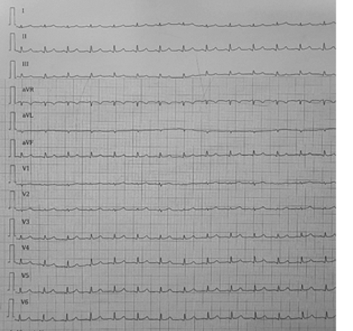 Electrocardiograma: Frecuencia Cardiaca
de 110 lpm, Ritmo Sinusal, eje cardiaco normal, ondas de bajo voltaje.