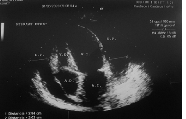 Se observa importante colapso de
cavidades derechas; con leve retardo y di&aacute;stole disminuida, se advierte
bamboleo apical, signos sugerentes de taponamiento cardiaco. Adem&aacute;s de derrame
peric&aacute;rdico.  Fuente: Resultados del estudio.