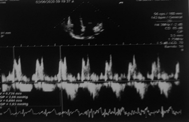 Funci&oacute;n sist&oacute;lica del VD
conservado TAPSE 22 mm, colapso mayor al 50 %. V&aacute;lvula mitral, tric&uacute;spide y
pulmonar con insuficiencia leve.