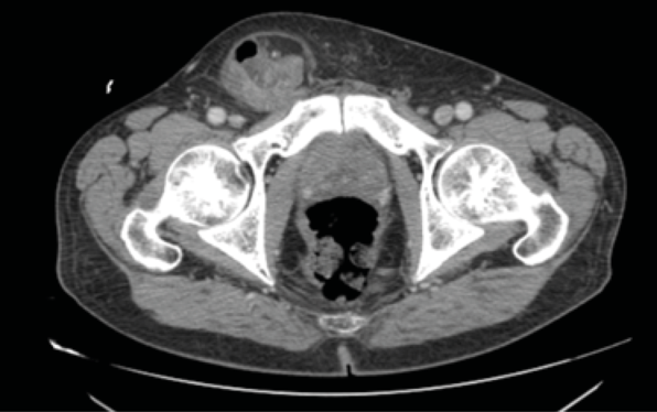 Tomograf&iacute;a axial computada. Corte
axial, hernia inguinal derecha