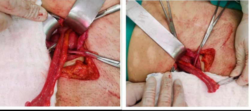 Hernia inguinal derecha. Ap&eacute;ndice cecal como contenido de saco.