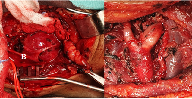 Abordaje
cervical izquierdo. Esternocleidomastoideo debatido en plano profundo. Se
observa A) Glomus carotideo cubierto por el B) nervio hipogloso.