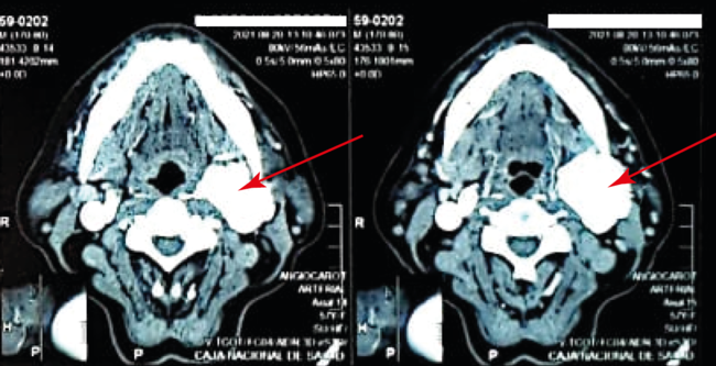 TAC bifurcación carotidea incluida dentro del Tumor flecha roja