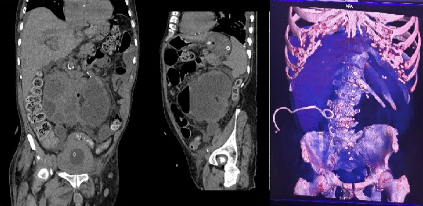 Se colocó catéter percutáneo guiado por ultrasonido como manejo mínimamente invasivo, para drenaje de material dentro de bolsa hidronefrótica y toma de muestras para cultivo