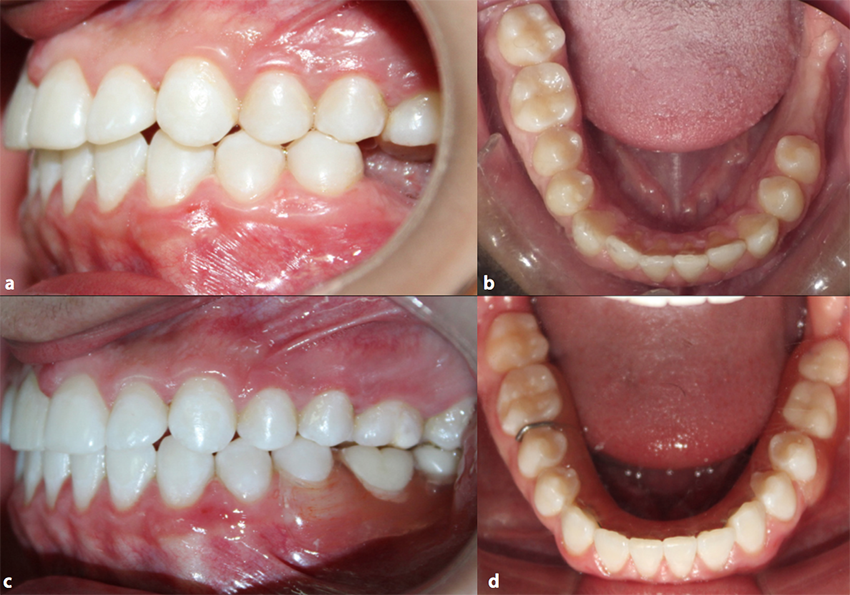 a. y b. Evaluación clínica intraoral, donde no se evidencia lesión patológica. c y d. Fotos intraorales con buenas relaciones oclusales y prótesis removible
