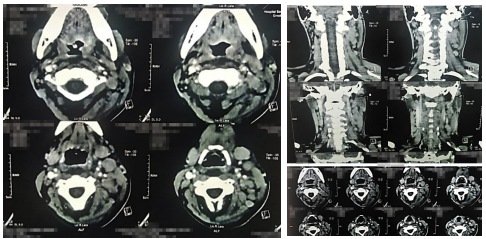 Tomografía axial computarizada de cuello