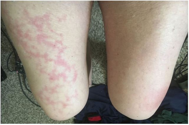 Livedo reticularis transitorio