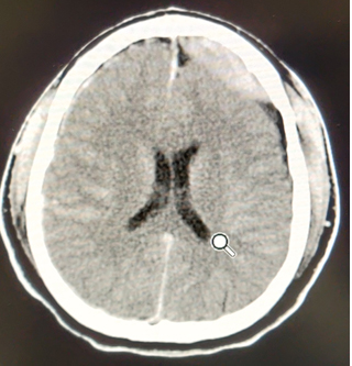 Figura 1. TAC: hematoma epidural frontal izquierdo y hemorragia subaracnoidea aguda.