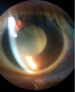 Figura 2. Ojo izquierdo, examen de cámara anterior: biomicroscopía.