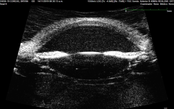 Figura 3. Ultrasonografía de cámara anterior: abundante celularidad, ángulos abiertos, no subluxación del cristalino.