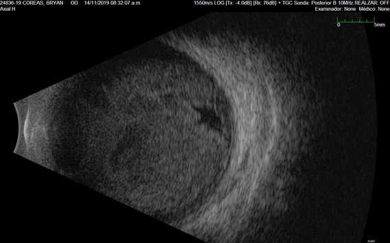 Figura 4. Ultrasonografia modo B del polo posterior: hemorragia vítrea masiva, retina aplicada, no anormalidades coroideas.