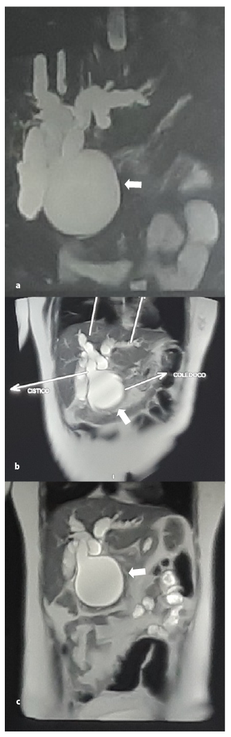 Resonancia Magnética Abdominal.