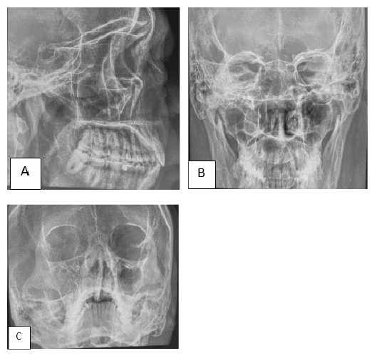 Radiografía con proyección lateral derecha (A), proyección de senos paranasales (B), proyección posteo anterior de Cadwell y Waters (C). Se observaron cambios en la densidad de los senos paranasales a predominio derecho y ocupación a nivel del seno maxilar derecho, que condiciona discreto adelgazamiento del piso de la órbita del mismo lado, con asimetría y
pérdida de diferenciación de los cornetes nasales.