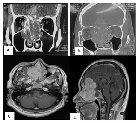 Tomografía de senos paranasales en corte coronal (A) con contraste y (B) sin contraste. Se observó una masa de tejidos blandos con infiltración, destrucción y extensión a ambos senos maxilares, paredes mediales de las órbitas y desplazamiento al músculo recto medial derecho lateralmente. Resonancia magnética cerebral (C) T1
corte axial y (D) corte sagital con contraste ferromagnético (gadolinio), que mostró un realce ávido de la lesión, de características infiltrantes a lámina cribiforme y hueso frontal con extensión a región intraconal derecha. No tenía extensión local a ganglios cervicales o torácicos (dato no evaluable en cortes presentados).