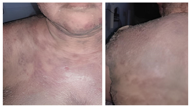 Placas descamativas eritematosas con tendencia a confluir que se intercalaban con áreas de piel sana, comprometiendo extensas áreas de la región anterior y dorsal del tórax