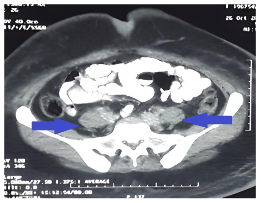Corte axial de tomografía abdominal identificando múltiples conglomerados de adenopatías para aorticas retroperitoneales (flechas)