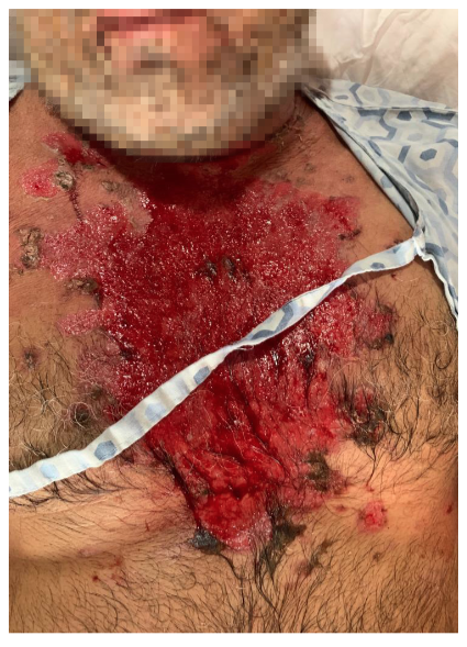 Estado de paciente post hidroterapiaF