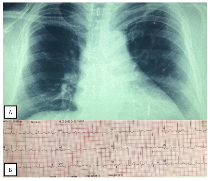 A. Radiografía de tórax de paciente al ingreso. B. electrocardiograma de paciente al ingreso