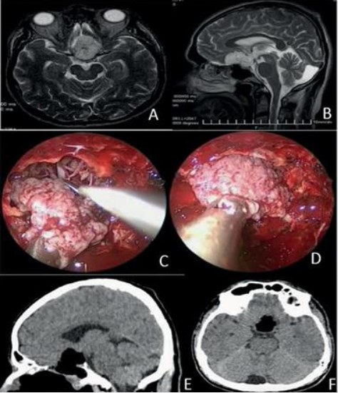 Abordaje endonasal transesfenoidal extendido
transplanum-transtubérculo.