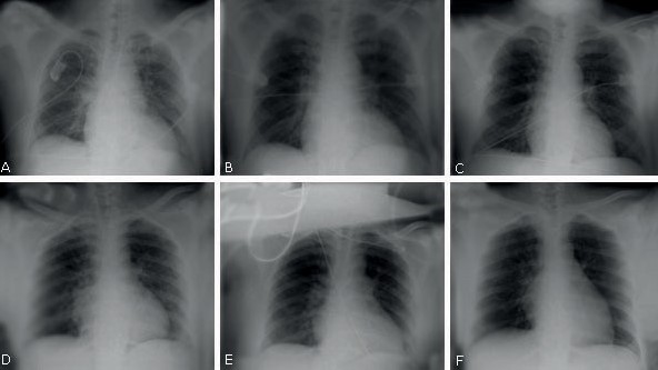 Las radiografías de tórax en serie muestran una recuperación significativa en 2 pacientes con COVID después del tratamiento con itolizumab.